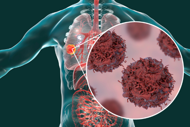 Lung Disease Test